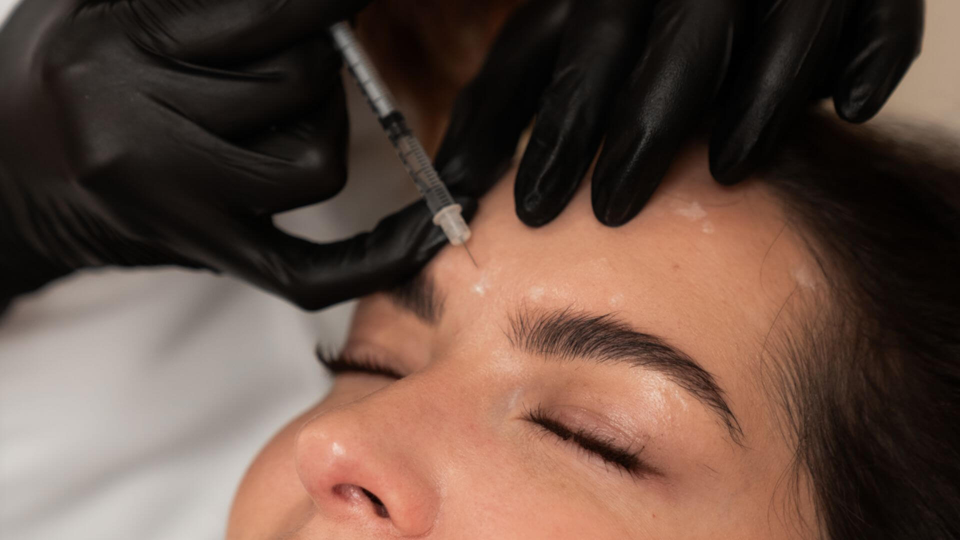 Botox alebo výplne? Čo rieši ktorý problém a kedy nemá zmysel ani jedno