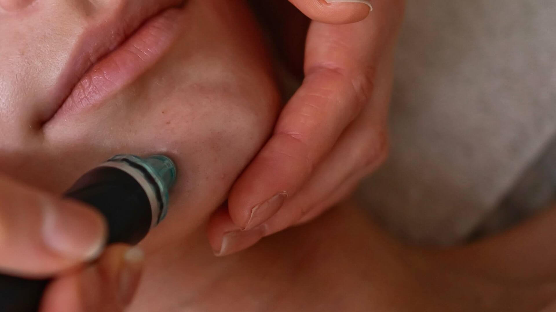 HydraFacial: šetrné reštartovanie pleti po dovolenke