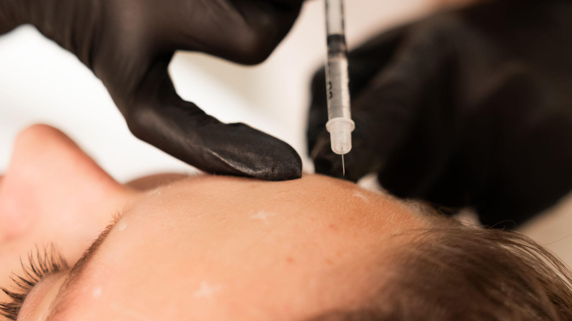Kedy nemá zmysel ani botox, ani výplň