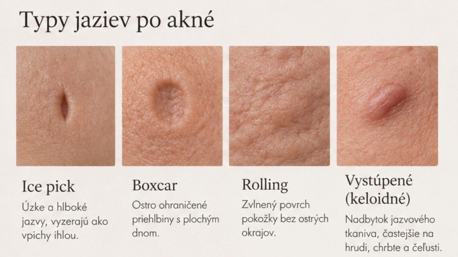 ako odstrániť jazvy po akné