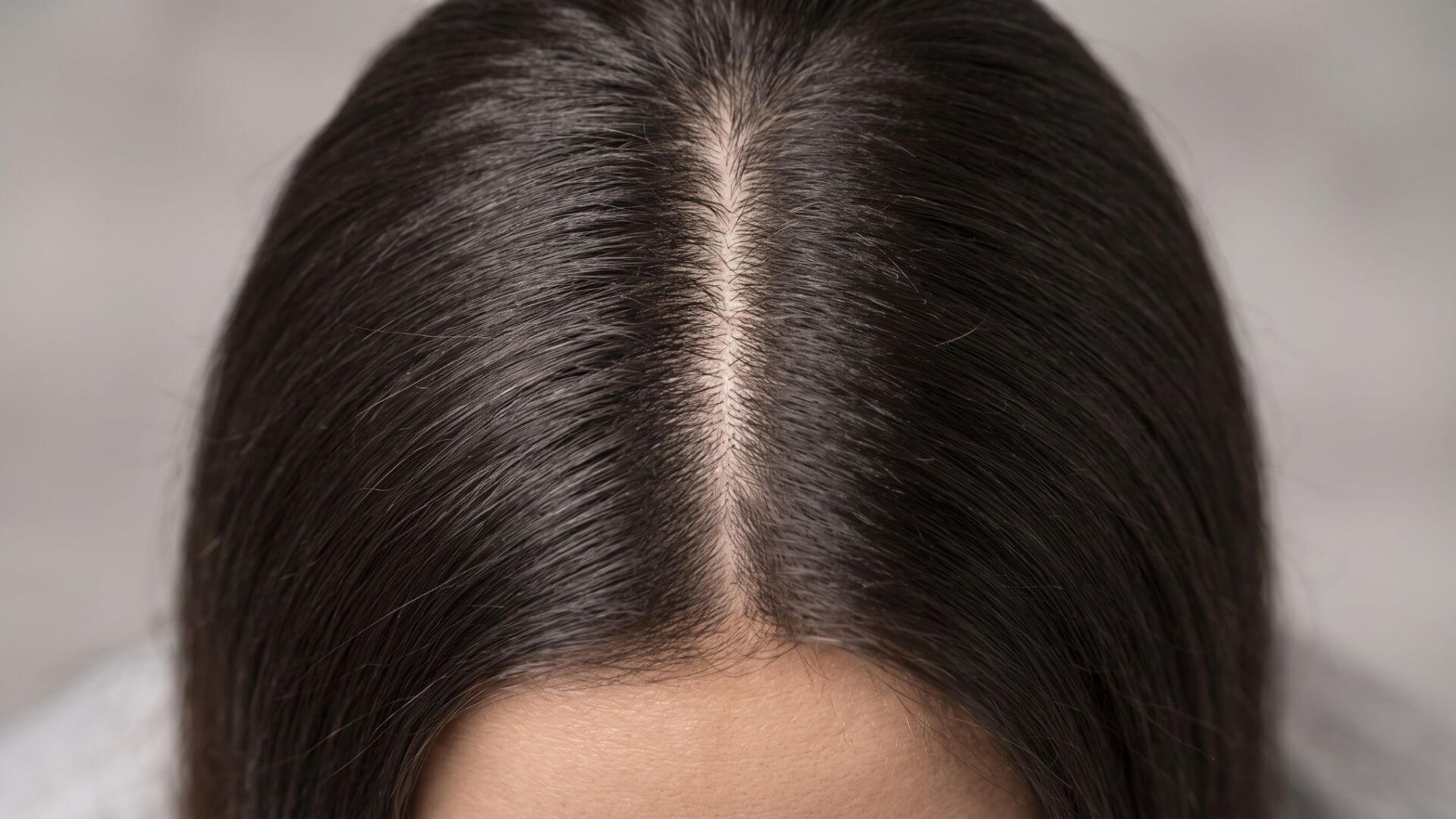 mezoterapia vlasov - beautylab - bratislava