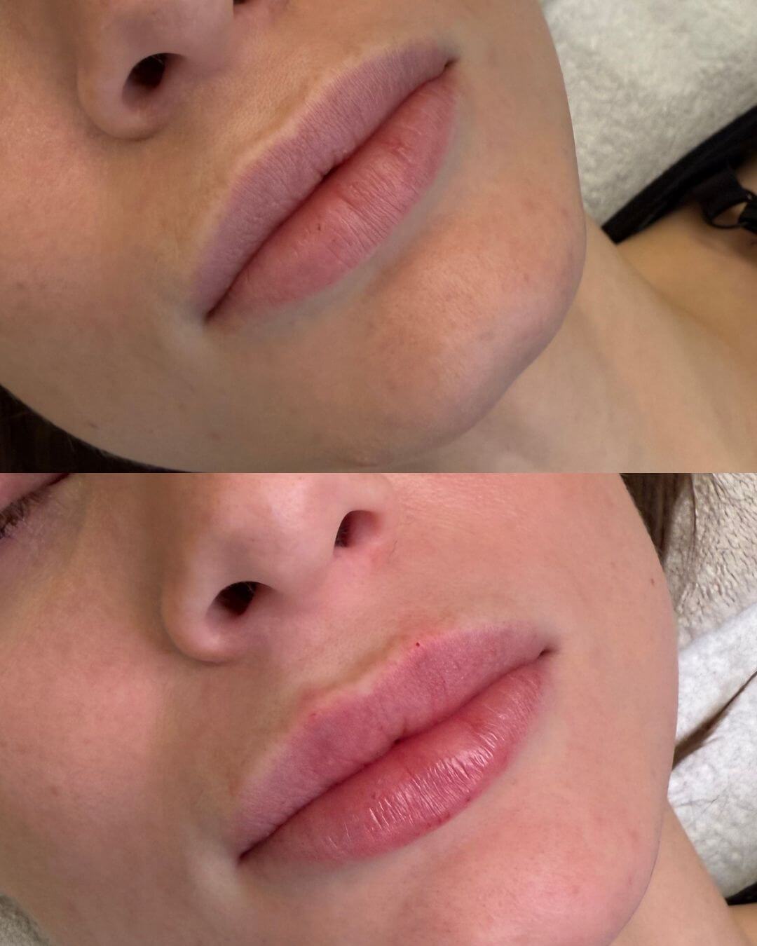 zväčšenie pier kyselina hyalurónová BeautyLab Bratislava