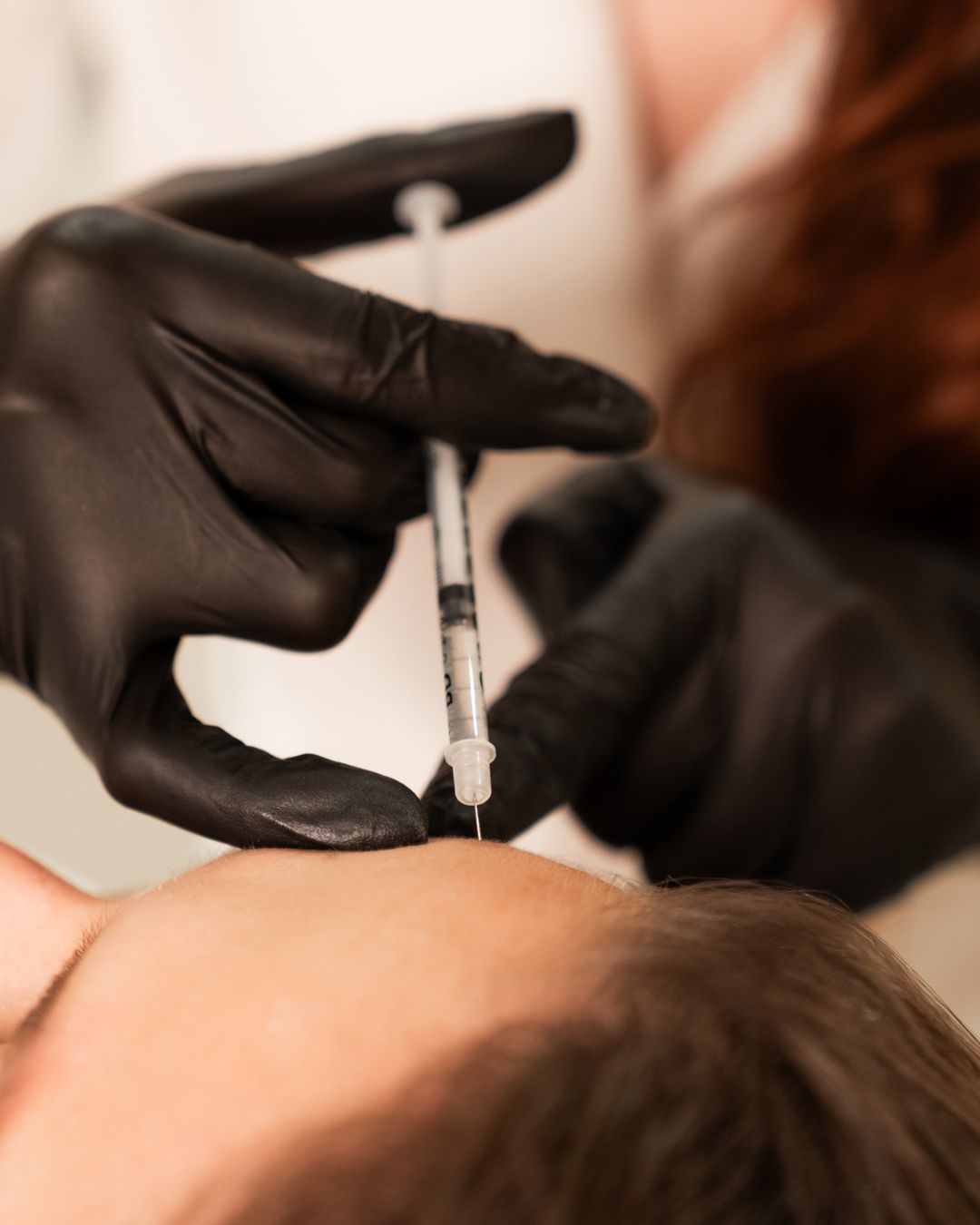 radiesse-kontura-sanka-brada-beautylab-bratislava.jpg