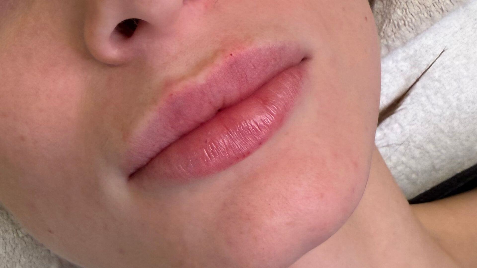 Výplň a modelácia pier Teosyal v BeautyLab Bratislava